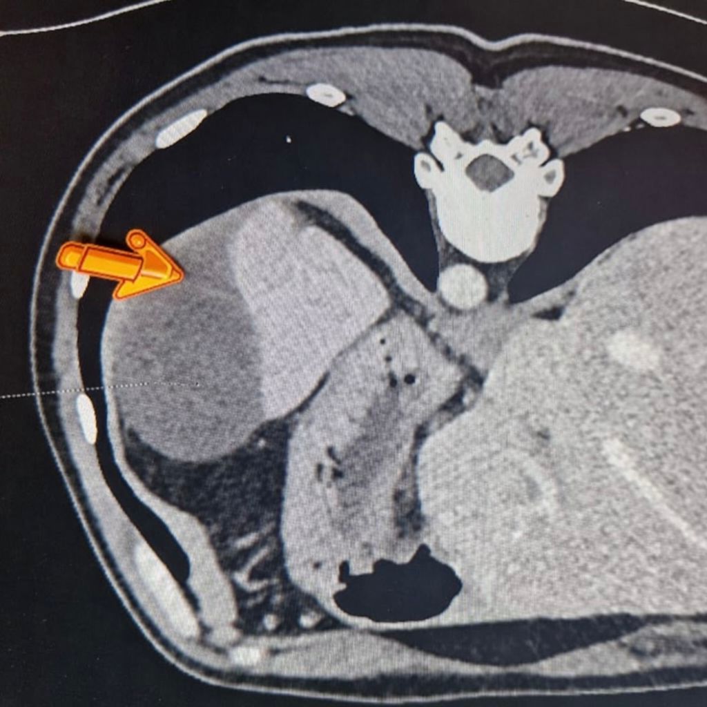 Дані спіральної комп’ютерної томографії показали розрив селезінки з&nbsp;формуванням великої гематоми. Фото: НВКМЦ